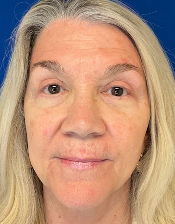 Blepharoplasty Before & After Gallery - Patient 149341363 - Image 2