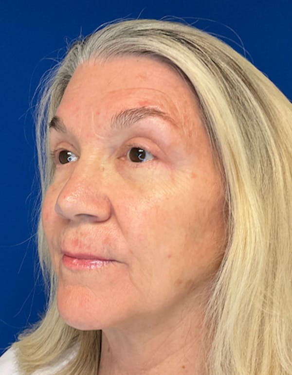 Blepharoplasty Before & After Gallery - Patient 149341363 - Image 4