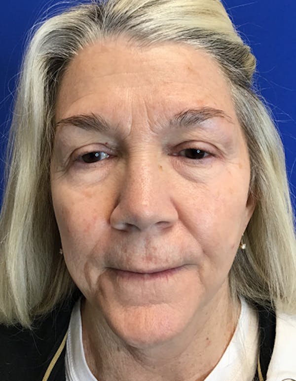 Blepharoplasty Before & After Gallery - Patient 149341363 - Image 1
