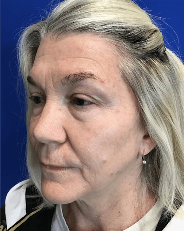 Blepharoplasty Before & After Gallery - Patient 149341363 - Image 3