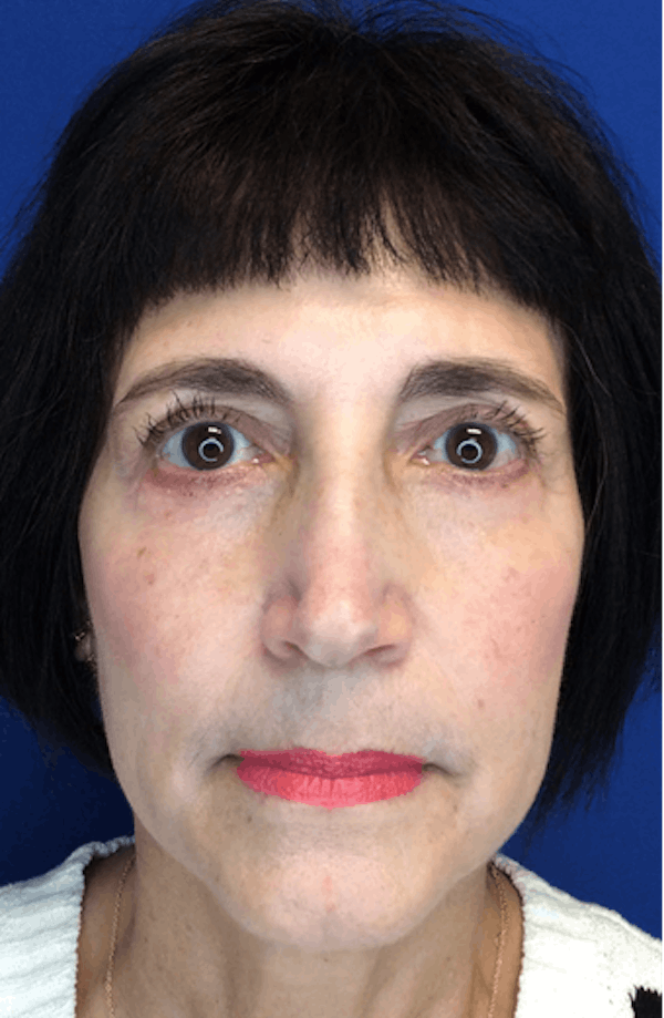 Blepharoplasty Before & After Gallery - Patient 149341366 - Image 2