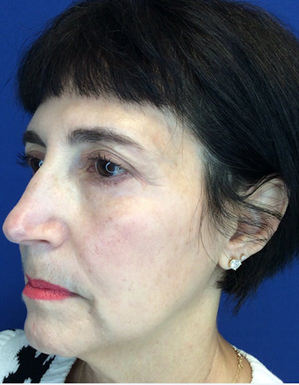 Blepharoplasty Before & After Gallery - Patient 149341366 - Image 4