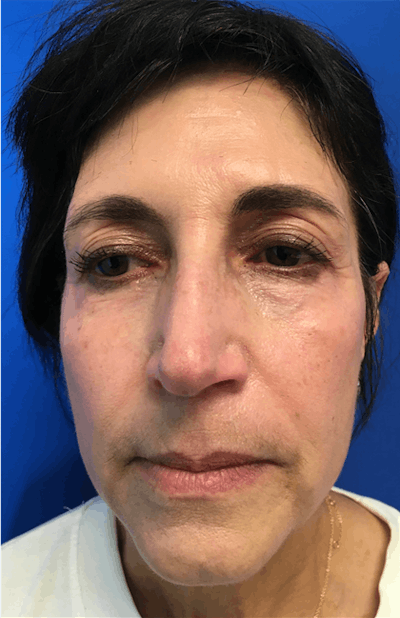 Blepharoplasty Before & After Gallery - Patient 149341366 - Image 1