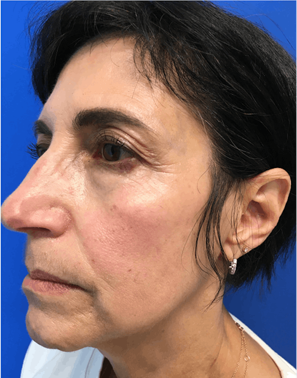Blepharoplasty Before & After Gallery - Patient 149341366 - Image 3