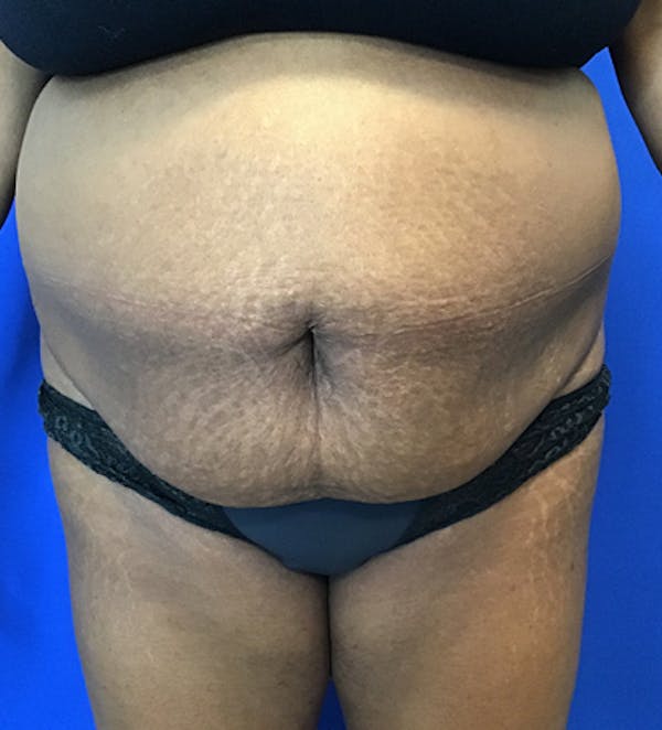 Tummy Tuck (Abdominoplasty) Before & After Gallery - Patient 149341381 - Image 1