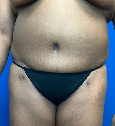 Tummy Tuck (Abdominoplasty) Before & After Gallery - Patient 149341381 - Image 2