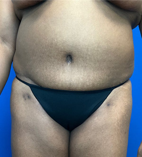 Tummy Tuck (Abdominoplasty) Before & After Gallery - Patient 149341381 - Image 2