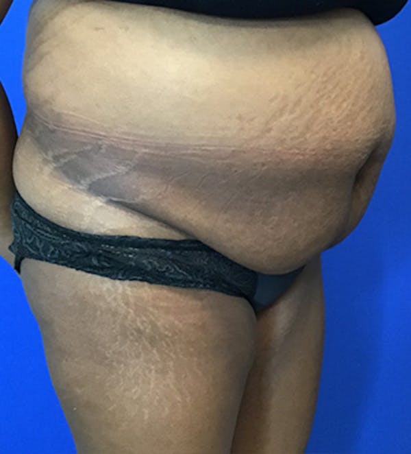 Tummy Tuck (Abdominoplasty) Before & After Gallery - Patient 149341381 - Image 3