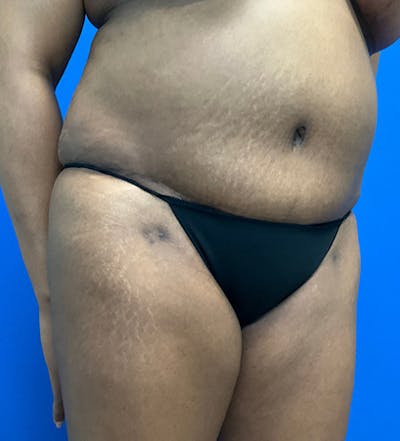 Tummy Tuck (Abdominoplasty) Before & After Gallery - Patient 149341381 - Image 4