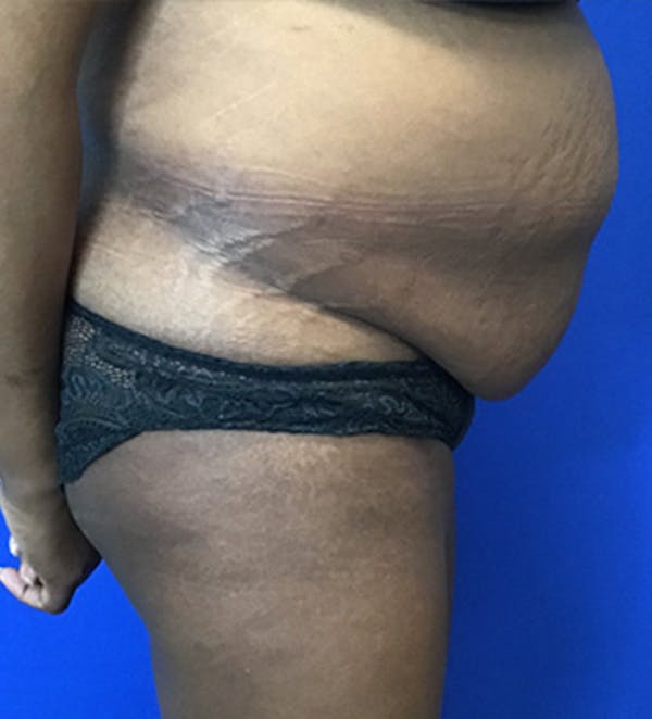 Tummy Tuck (Abdominoplasty) Before & After Gallery - Patient 149341381 - Image 5