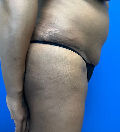 Tummy Tuck (Abdominoplasty) Before & After Gallery - Patient 149341381 - Image 6