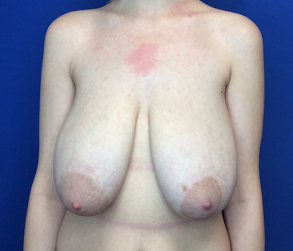 Breast Reduction Before & After Gallery - Patient 149341482 - Image 1