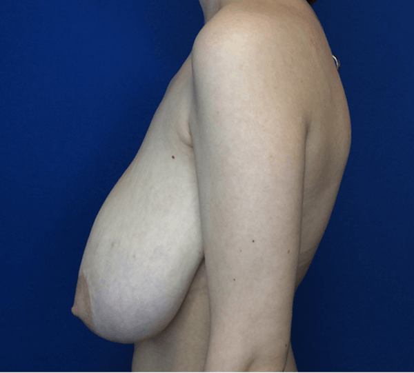 Breast Reduction Before & After Gallery - Patient 149341482 - Image 5