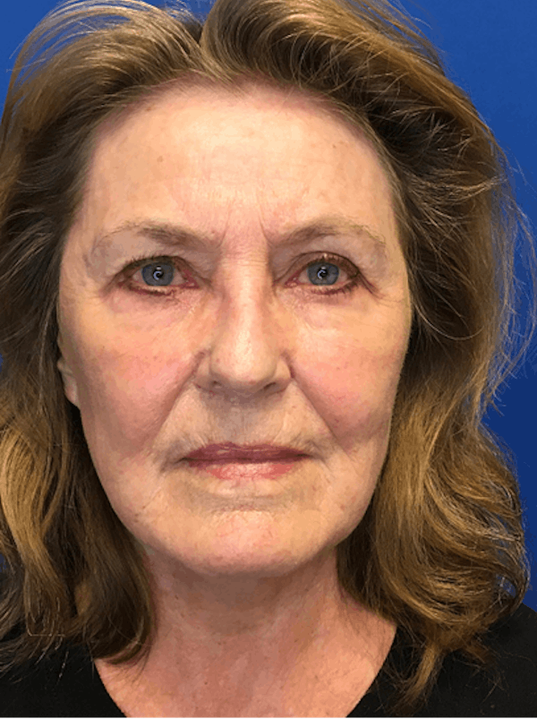 Neck Lift