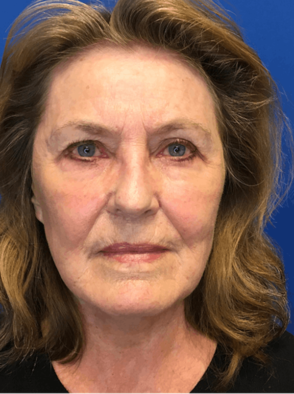 Neck Lift Before & After Gallery - Patient 149341557 - Image 2