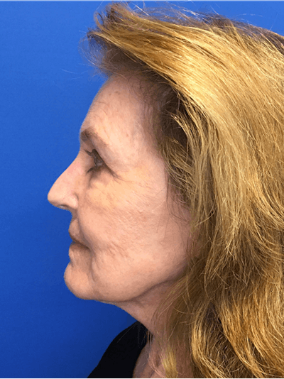 Face Lift Before & After Gallery - Patient 149341555 - Image 2
