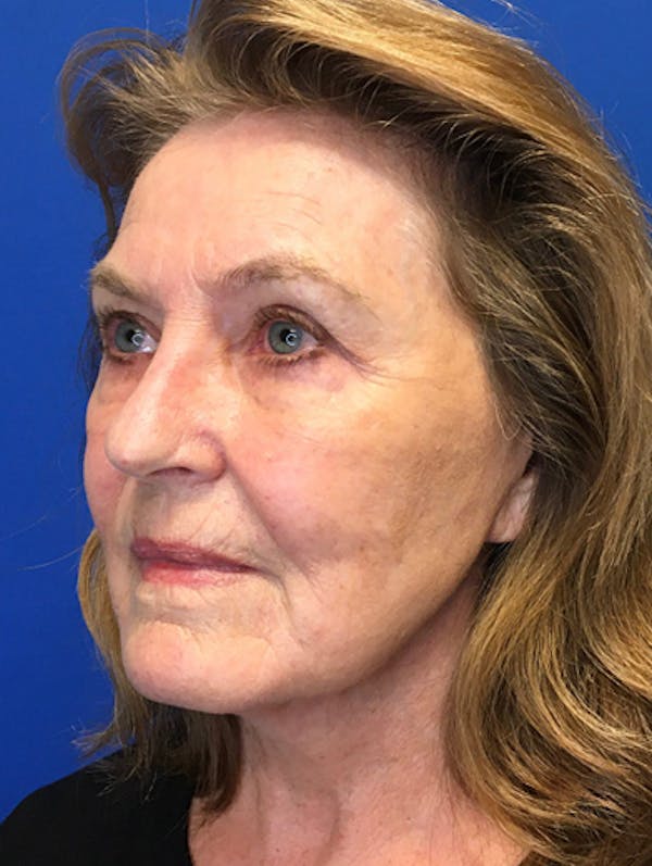 Blepharoplasty Before & After Gallery - Patient 149341561 - Image 4