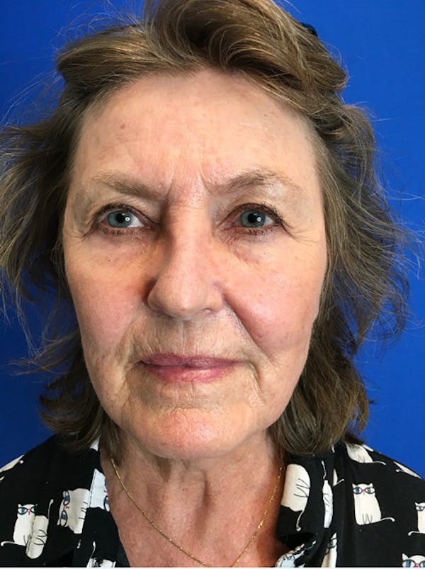 Face Lift Before & After Gallery - Patient 149341555 - Image 3