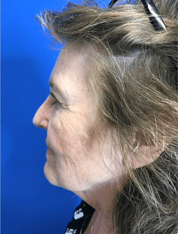 Face Lift Before & After Gallery - Patient 149341555 - Image 1