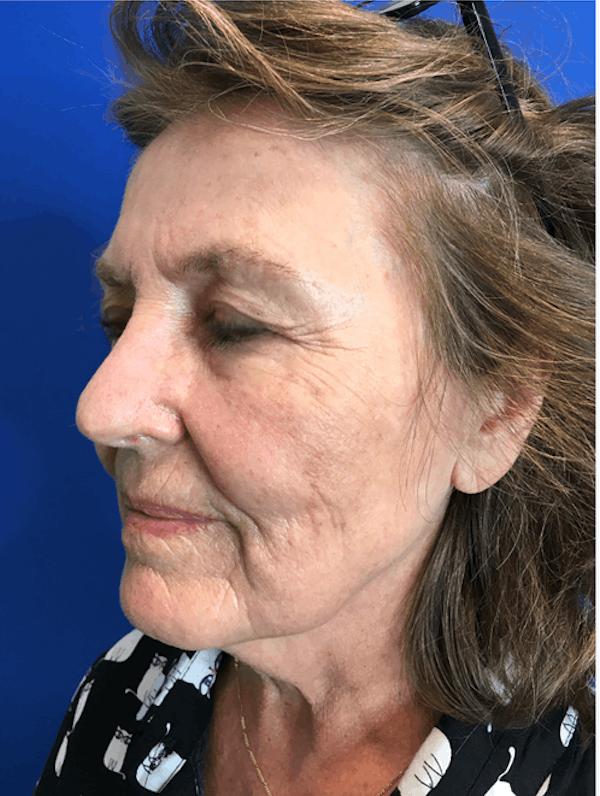 Face Lift Before & After Gallery - Patient 149341555 - Image 5