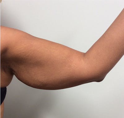 Arm Lift Before & After Gallery - Patient 149341791 - Image 1