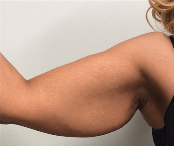 Arm Lift Before & After Gallery - Patient 149341791 - Image 3