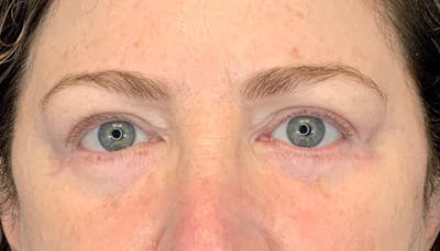 Blepharoplasty Before & After Gallery - Patient 149341794 - Image 2