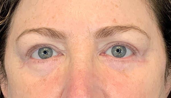 Blepharoplasty Before & After Gallery - Patient 149341794 - Image 2