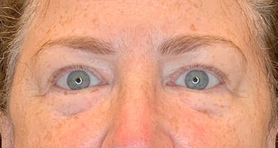 Blepharoplasty Before & After Gallery - Patient 149341794 - Image 1
