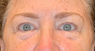 Blepharoplasty Before & After Gallery - Patient 149341794 - Image 1