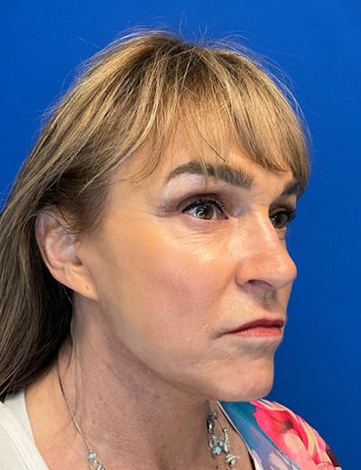 Neck Lift Before & After Gallery - Patient 149341806 - Image 4