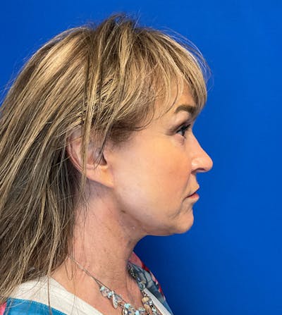 Face Lift Before & After Gallery - Patient 149341805 - Image 2