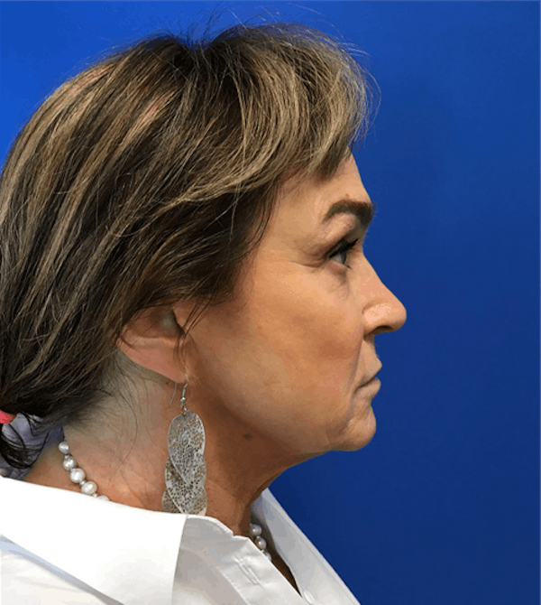 Neck Lift Before & After Gallery - Patient 149341806 - Image 5