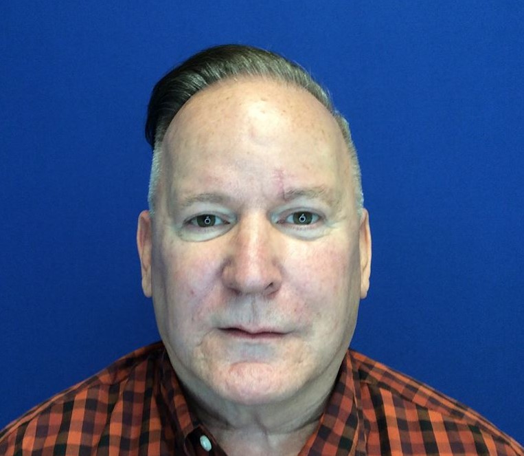 Hair Restoration