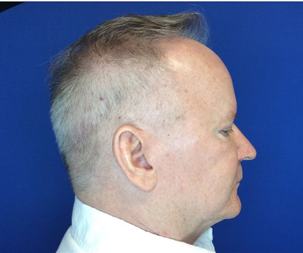 Hair Restoration Before & After Gallery - Patient 149341895 - Image 5