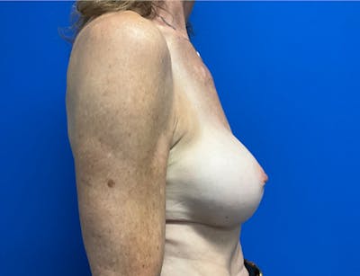 Breast Implant Removal and Replacement Before & After Gallery - Patient 149341902 - Image 6