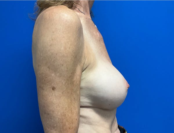 Breast Implant Removal and Replacement Before & After Gallery - Patient 149341902 - Image 6