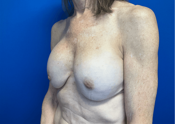 Breast Implant Removal and Replacement Before & After Gallery - Patient 149341902 - Image 3