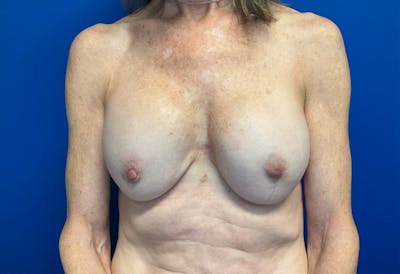 Breast Implant Removal and Replacement Before & After Gallery - Patient 149341902 - Image 1
