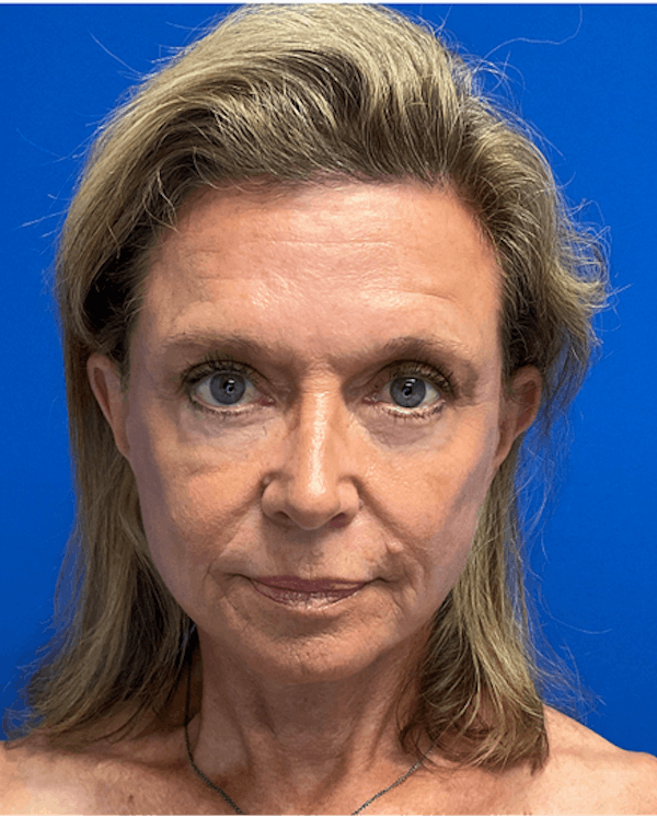 Blepharoplasty Before & After Gallery - Patient 149341915 - Image 2
