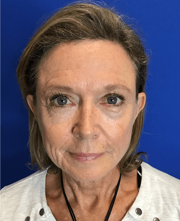 Face Lift Before & After Gallery - Patient 149341916 - Image 3