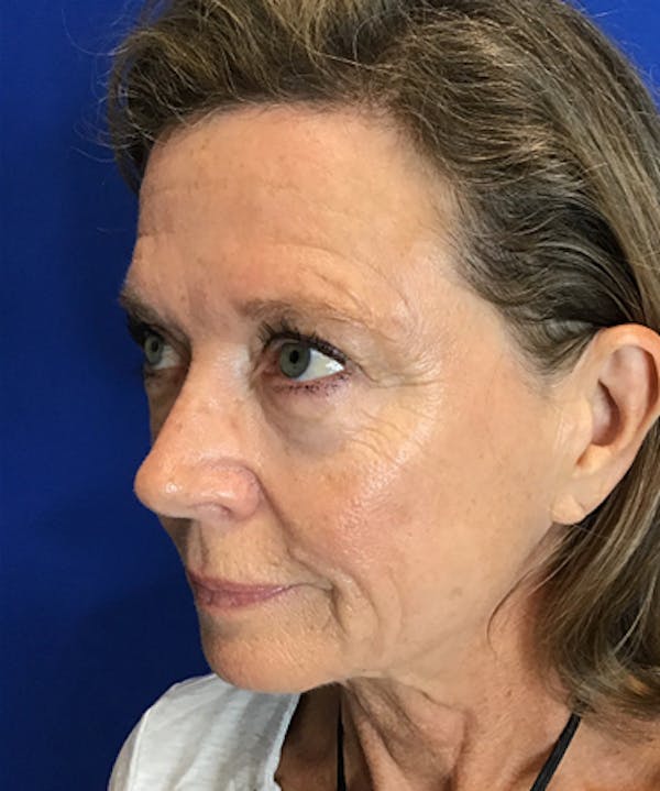 Neck Lift Before & After Gallery - Patient 149341917 - Image 3