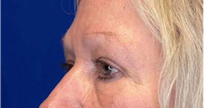 Blepharoplasty Before & After Gallery - Patient 149341926 - Image 2