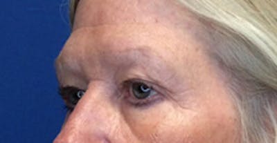 Brow Lift Before & After Gallery - Patient 149341927 - Image 1