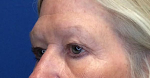 Blepharoplasty Before & After Gallery - Patient 149341926 - Image 1