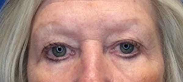 Brow Lift Before & After Gallery - Patient 149341927 - Image 3