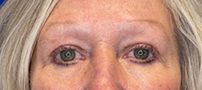 Blepharoplasty Before & After Gallery - Patient 149341926 - Image 4