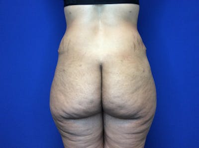 Brazilian Butt Lift Before & After Gallery - Patient 149341997 - Image 1