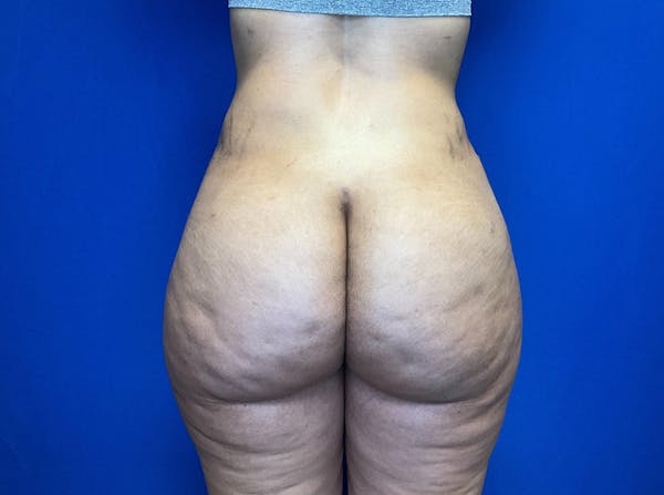 Brazilian Butt Lift Before & After Gallery - Patient 149341997 - Image 2
