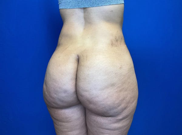 Brazilian Butt Lift Before & After Gallery - Patient 149341997 - Image 4